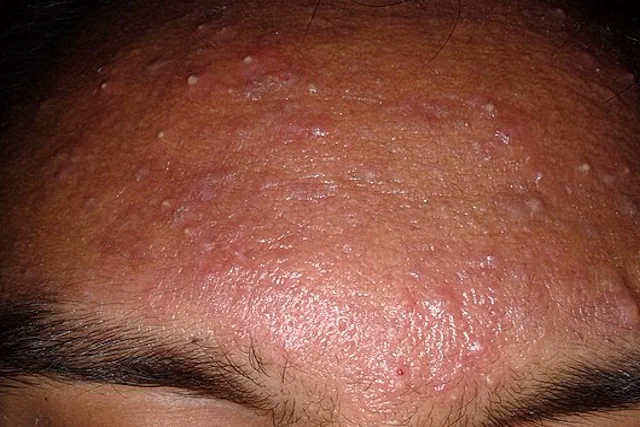 Tratamientos Naturales para el Acné