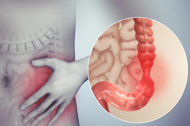 Tratamientos para el Colon Irritable