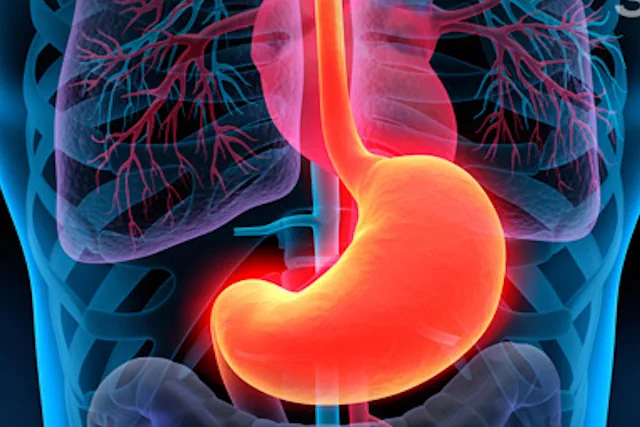 Tratamientos Naturales para la Gastritis