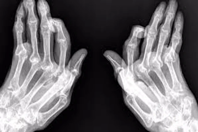 Consecuencias de Tener Osteoporosis y No Tratarla