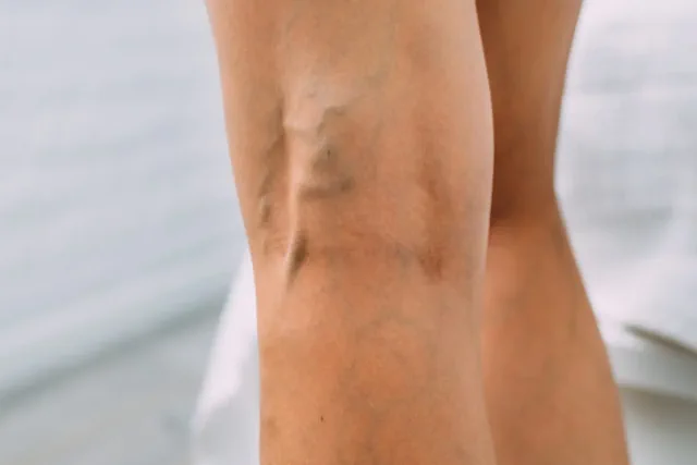 Consecuencias de las Várices y Cómo los Suplementos Pueden Ayudar